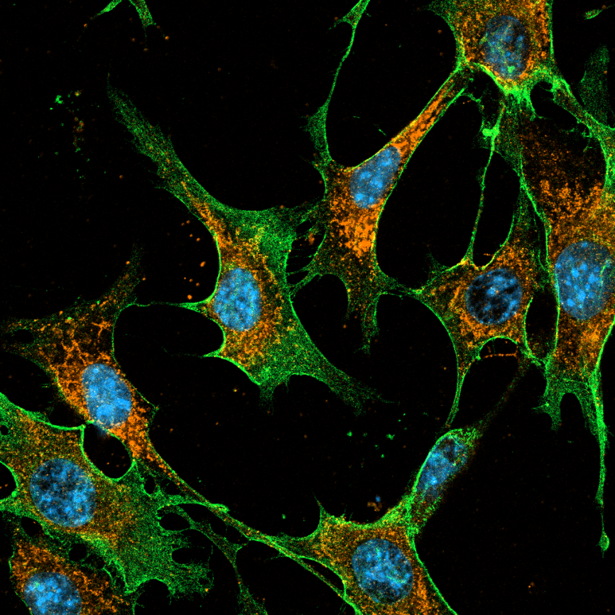 Pancreatic_tumor_expressing_CD44v6_and_MET_2