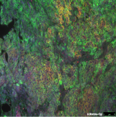 Tumor CD44 staining_2